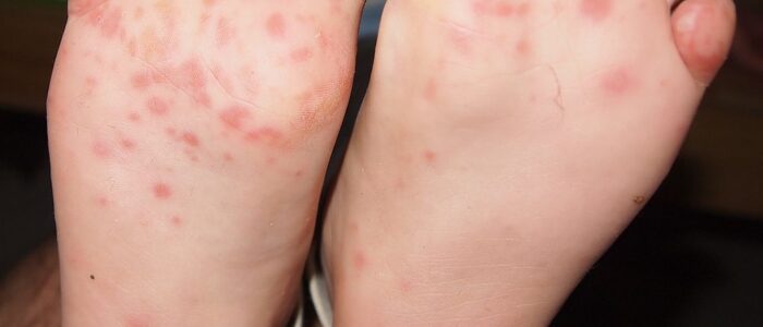 Hand Foot Mouth Disease rash on child's foot - Ngufra at English Wikipedia, CC BY-SA 3.0 , via Wikimedia Commons