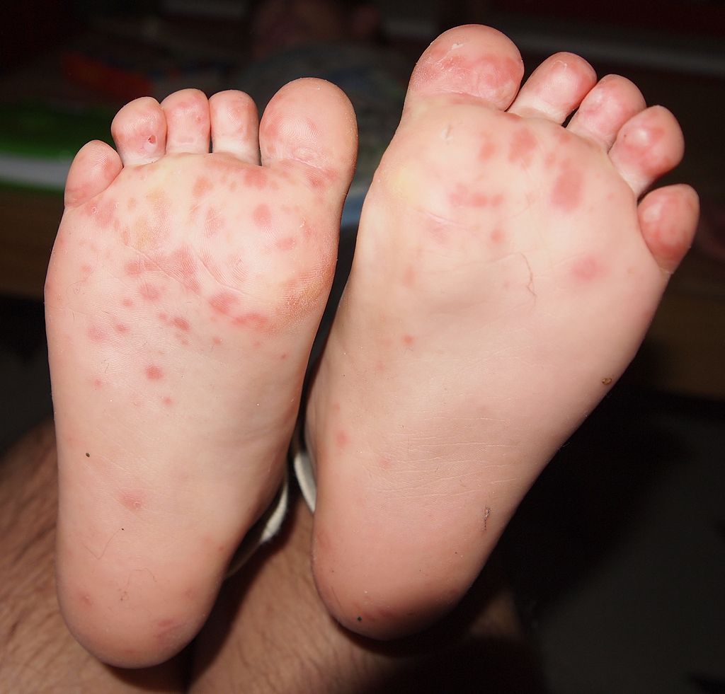 Hand Foot Mouth Disease rash on child's foot - Ngufra at English Wikipedia, CC BY-SA 3.0 <https://creativecommons.org/licenses/by-sa/3.0>, via Wikimedia Commons