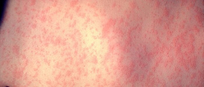 Measles rash - Measles Outbreak in Florida post